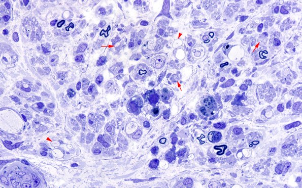 1C6 CIDP (Case 1) Plastic 100X 3 copy copy