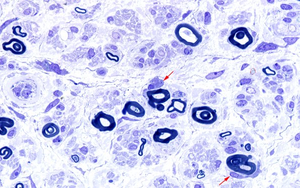 1C7 CIDP (Case 1) Plastic 100X 1 copy