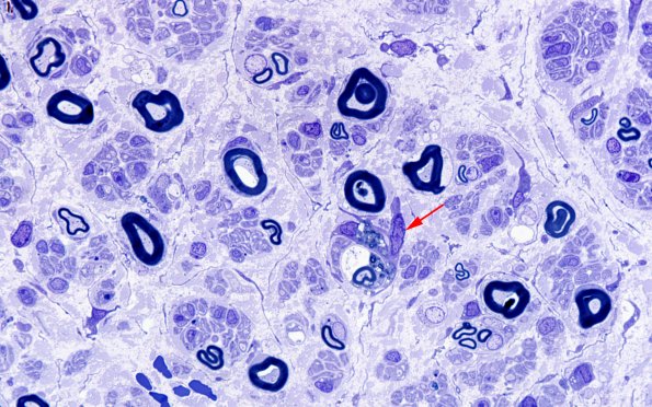 1C8 CIDP (Case 1) Plastic 100X 2 copy