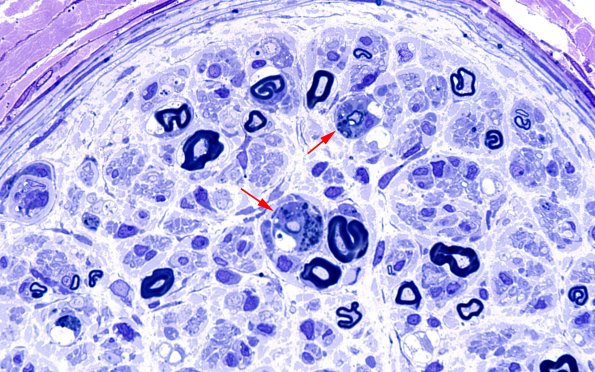 1C9 CIDP (Case 1) Plastic 100X 4 copy