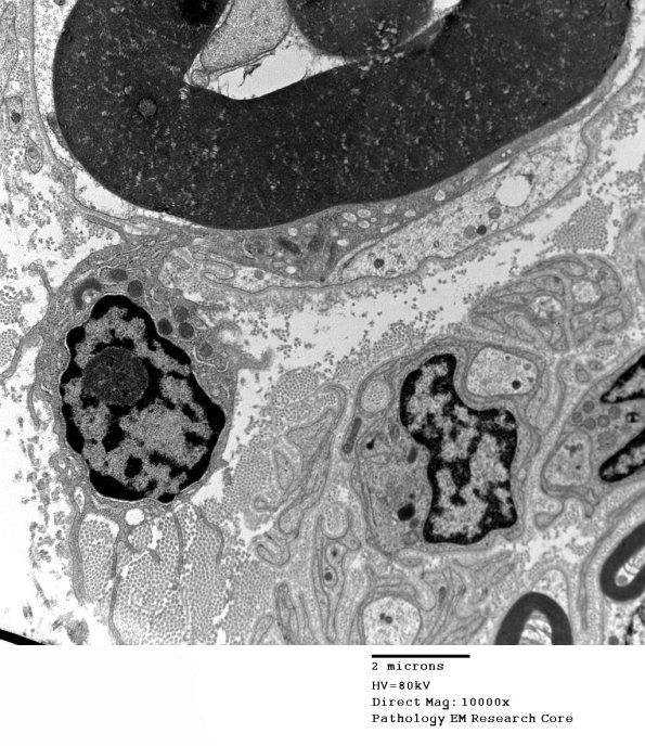 1D1 CIDP  (Case 1) EM 056 - Copy