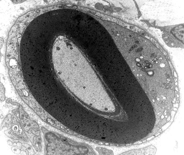 1D10A CIDP (Case 1) EM 6 (2) - Copy