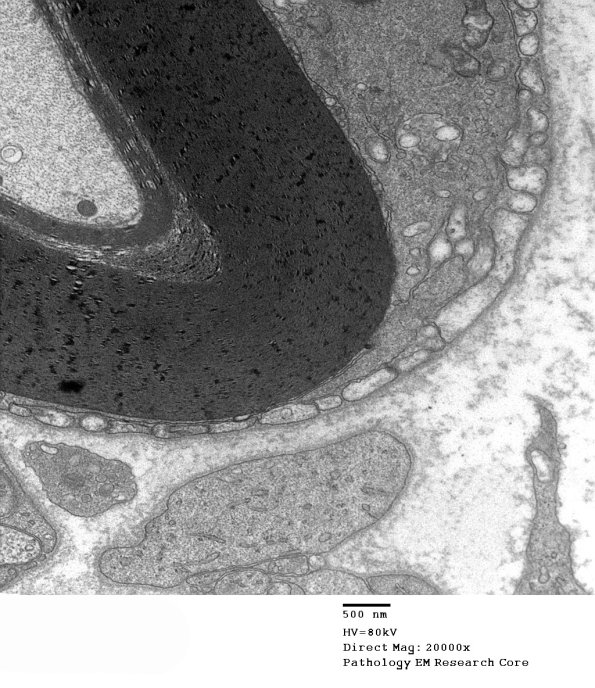 1D10B CIDP (Case 1) EM 4 - Copy