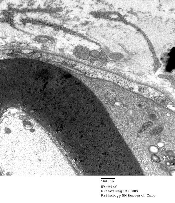 1D10C CIDP (Case 1) EM 5 - Copy