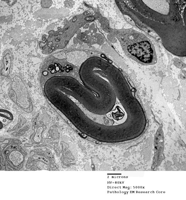 1D11 CIDP (Case 1 EM 010 - Copy