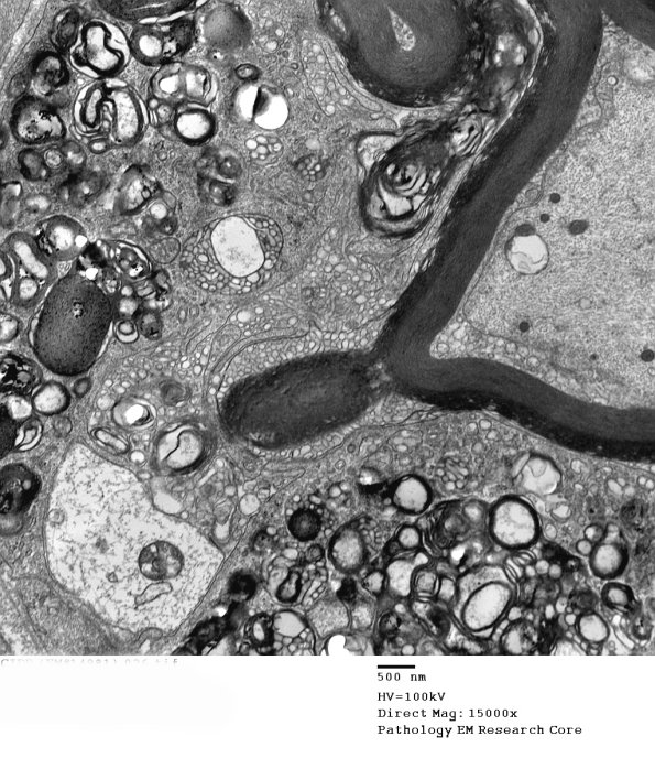 1D12B CIDP (Case 1)_026 - Copy