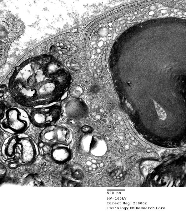 1D12C CIDP (Case 1)_027 - Copy