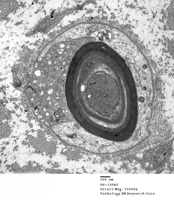 1D13A CIDP (Case 1)_013 - Copy
