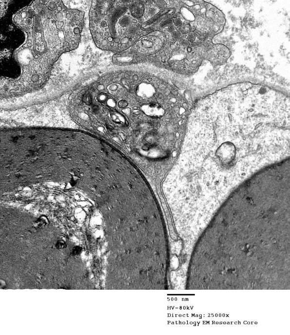 1D14 CIDP (Case 1)  EM 015 - Copy