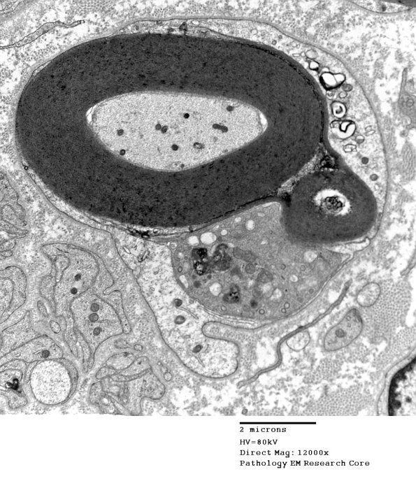 1D16 CIDP  (Case 1) EM 037 - Copy