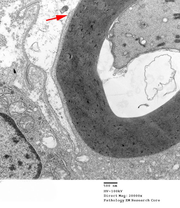 1D17B CIDP (Case 1)_007 copy - Copy