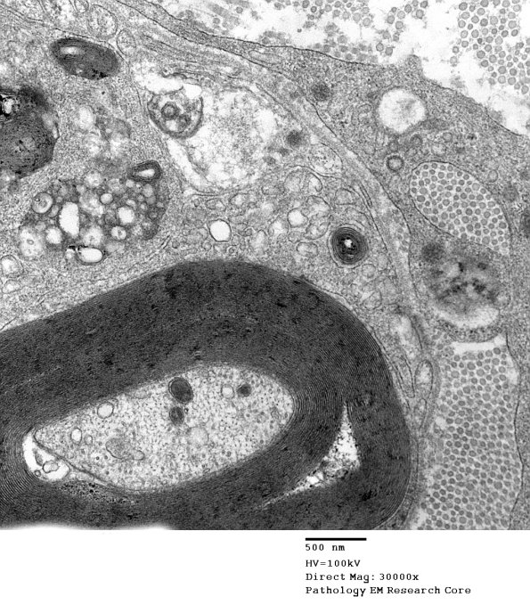 1D18B CIDP (Case 1)_003 - Copy