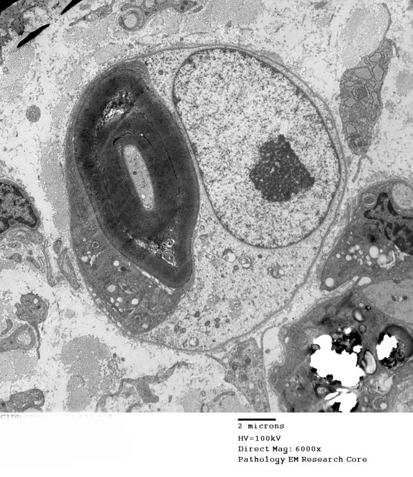 1D19A CIDP (Case 1)_032 - Copy