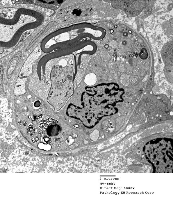 1D1B CIDP (Case 1) EM 046 - Copy