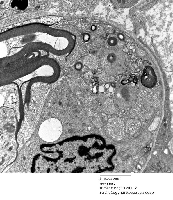 1D1C CIDP (Case 1) EM 047 - Copy