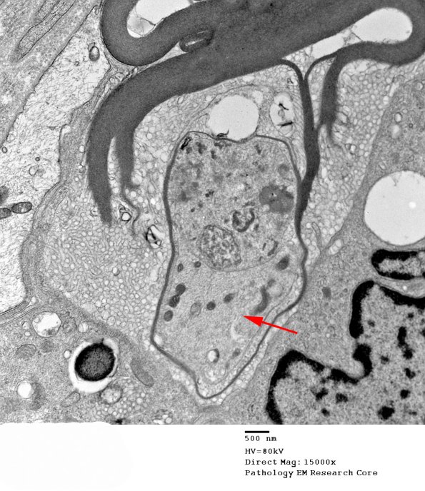 1D1D CIDP (Case 1) EM 048 - Copy copy