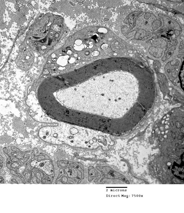 1D20A CIDP (Case 1 A7) 005 - Copy