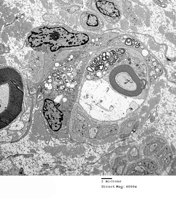 1D21 CIDP Case 1 A7) EM 029 - Copy