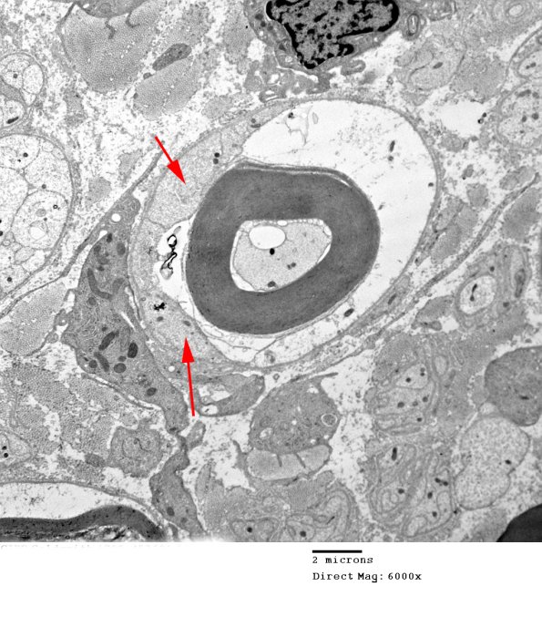 1D23 CIDP  (Case 1)_020 - Copy copy