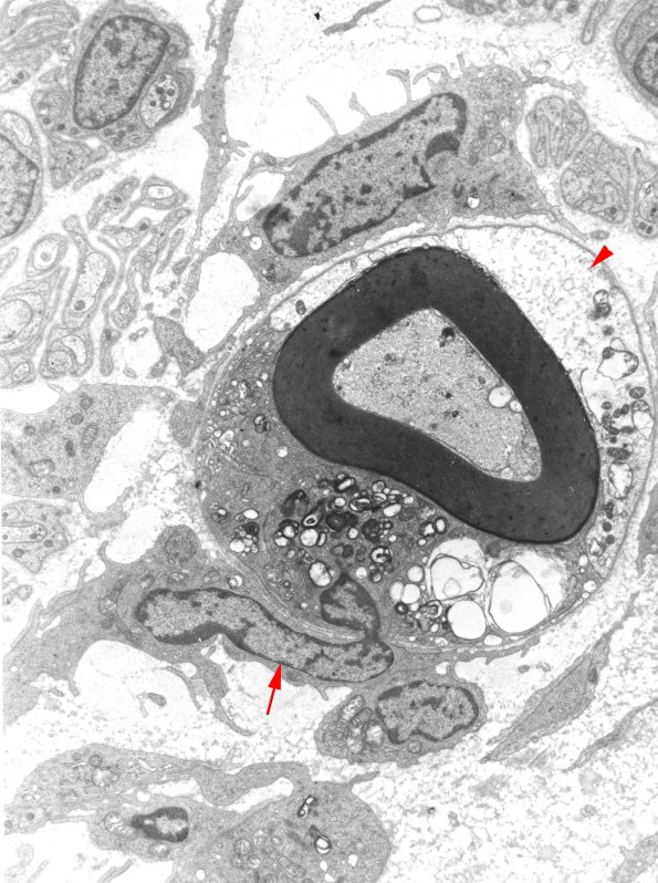 1D2A CIDP (Case 1) EM 12 - Copy copy