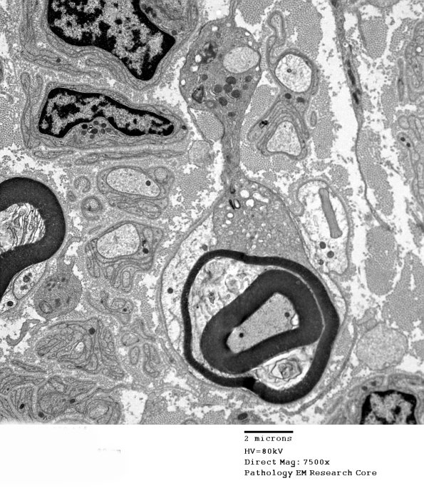 1D4 CIDP (Case 1) EM 039 - Copy