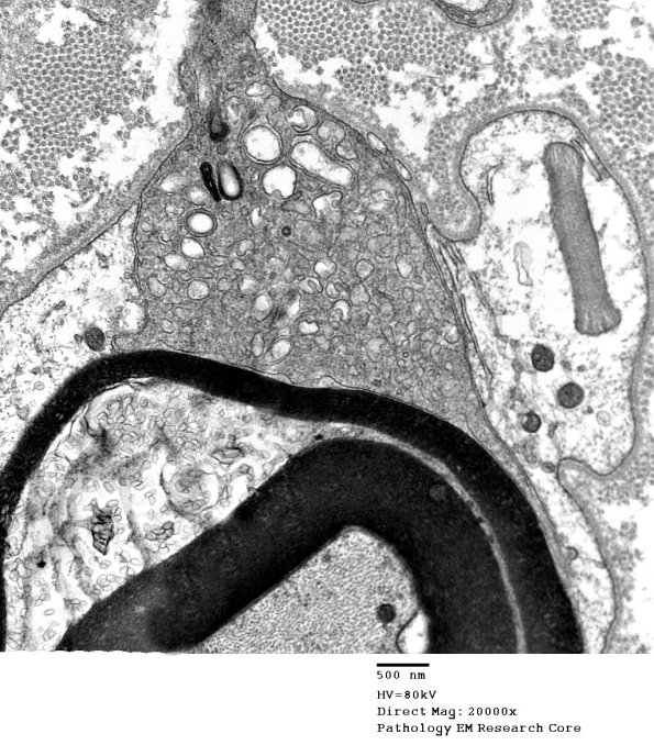 1D4 CIDP (Case 1) EM 040 - Copy