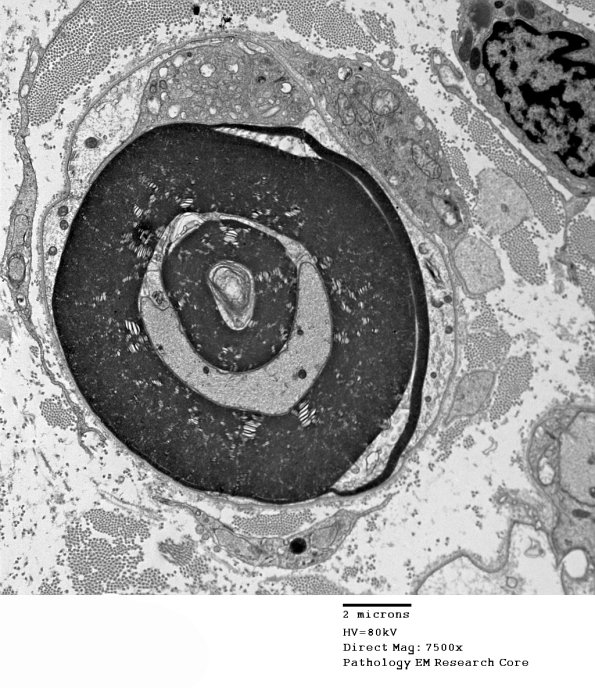 1D5A CIDP (Case 1) EM 064 - Copy