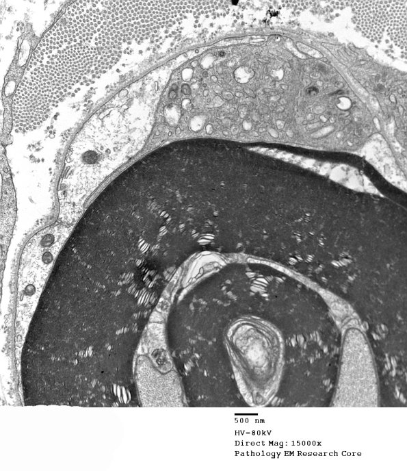 1D5B CIDP (Case 1) EM 065 - Copy