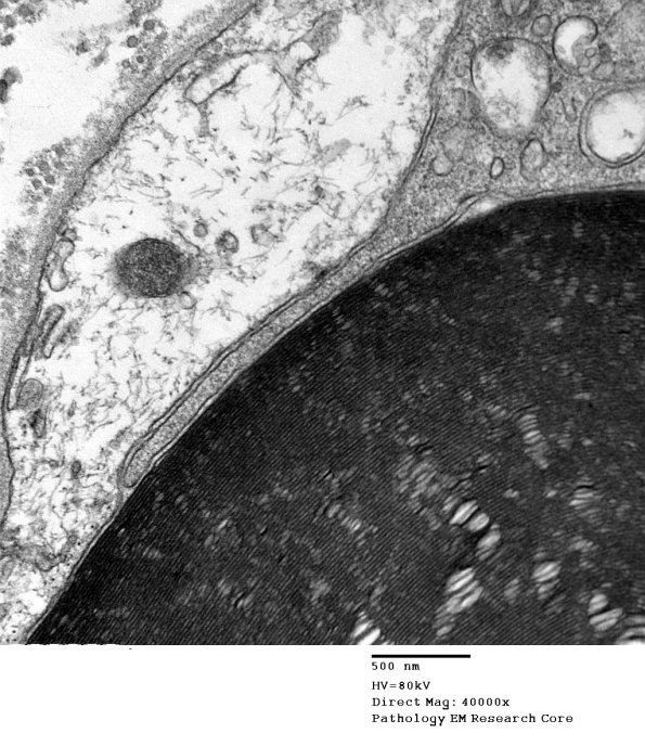 1D5C CIDP (Case 1) EM 066 - Copy
