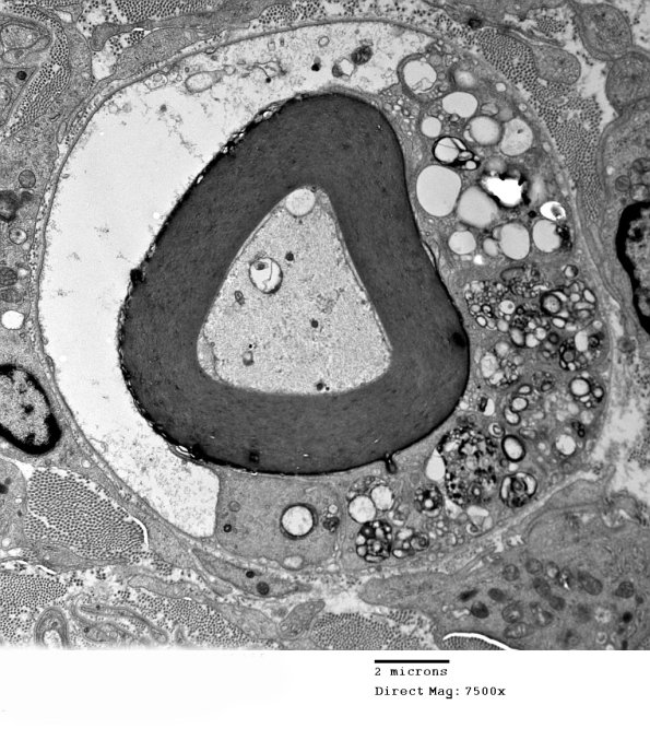 1D6A CIDP (Case 1)_046 - Copy