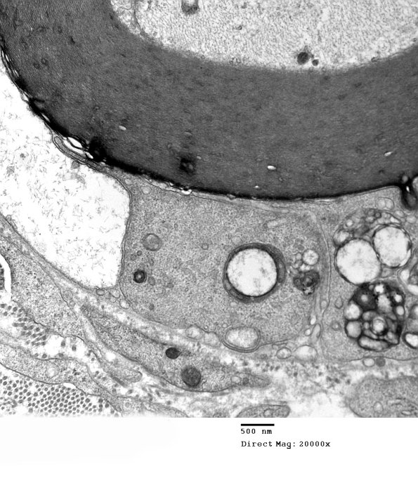 1D6B CIDP (Case 1)_047 - Copy