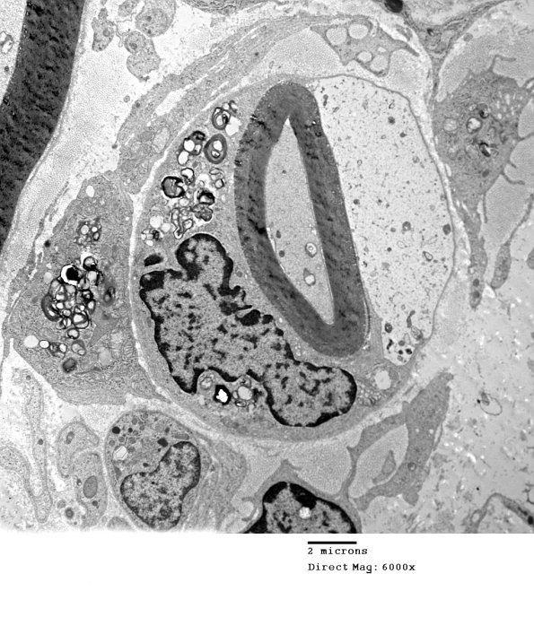 1D7A CIDP (Case 1)_050 - Copy