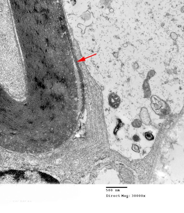 1D7B CIDP (Case 1)_053 - Copy copy