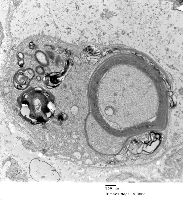 1D8A CIDP (Case 1_055 - Copy