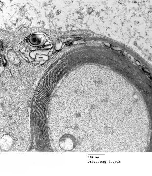 1D8B CIDP (Case 1)_056 - Copy