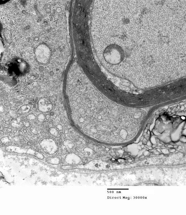 1D8C CIDP (Case 1)_057 - Copy