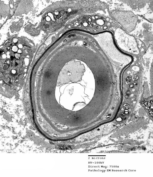 1D9A CIDP (Case 1) EM 015 - Copy