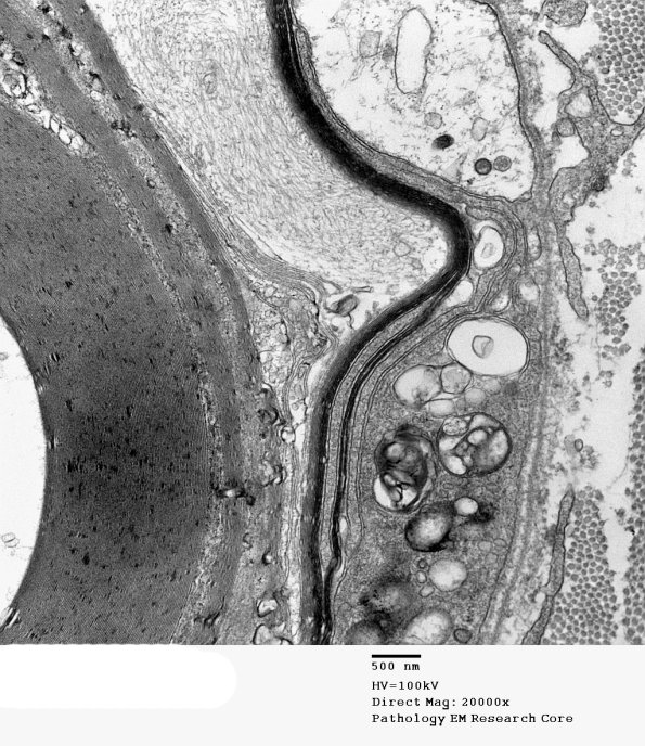 1D9B CIDP (Case 1) EM 016 - Copy