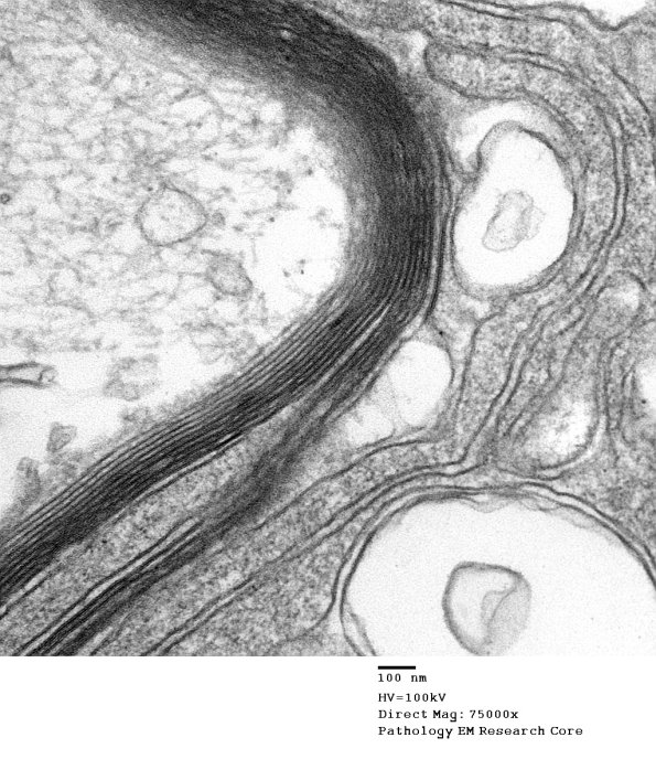 1D9C CIDP (Case 1) EM 018 - Copy