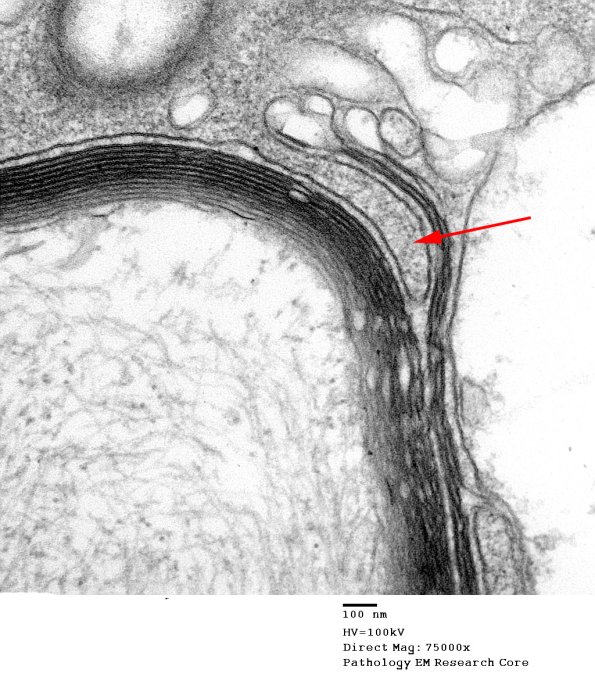 1D9D CIDP (Case 1) EM 021 - Copy copy