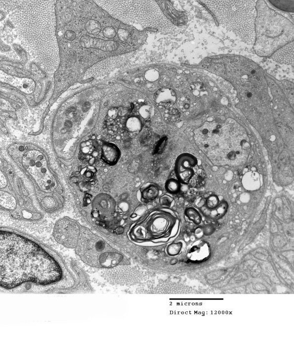 1E11A CIDP  (Case 1)_012 - Copy
