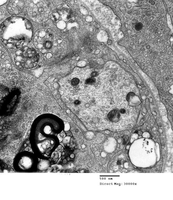 1E11B CIDP  (Case 1)_013 - Copy