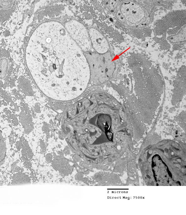 1E2 CIDP Case 1)_004 - Copy copy