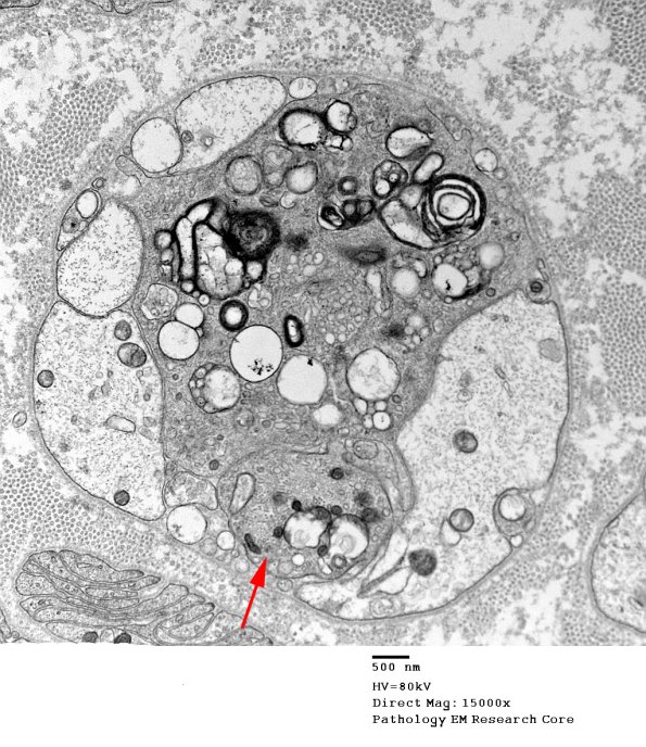 1E3 CIDP (Case 1) EM 087 - Copy copy