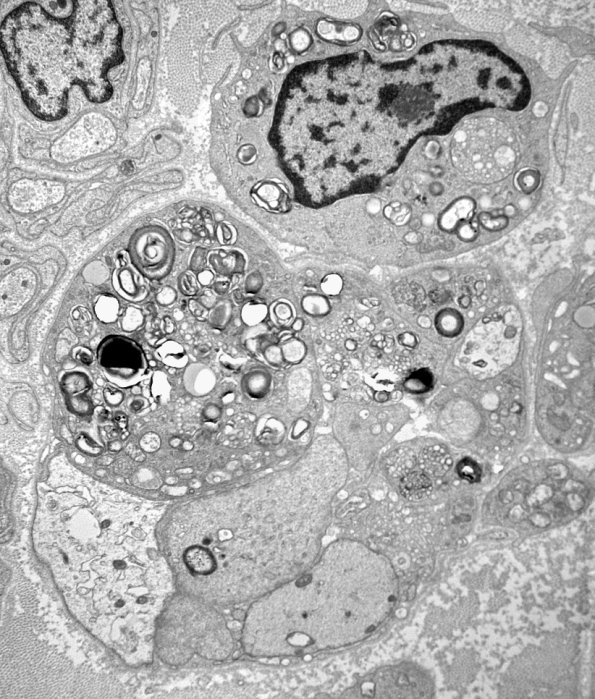 1E5A CIDP (Case 1) EM 026 - Copy