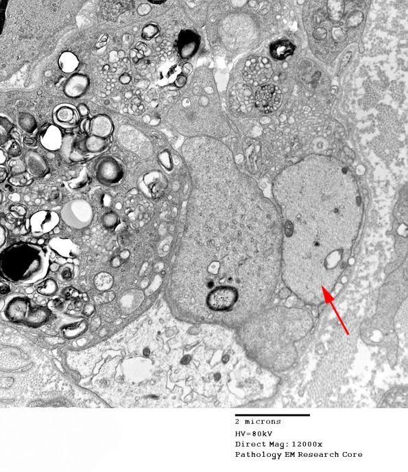 1E5B CIDP (Case 1) EM 027 - Copy copy