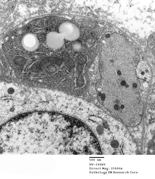 1E6B CIDP (Case 1)_005 - Copy