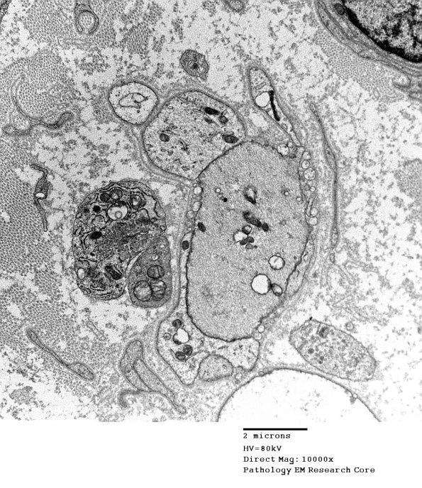 1E8 CIDP  (Case 1) EM 013A - Copy
