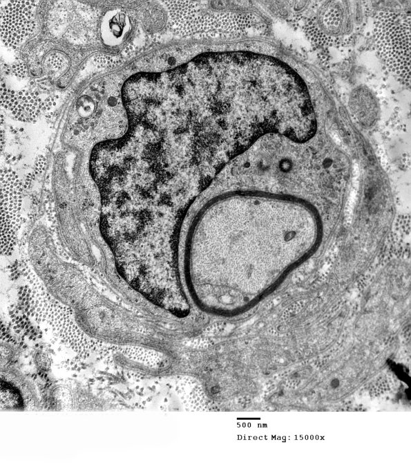 1F1A CIDP (Case 1)_040 - Copy