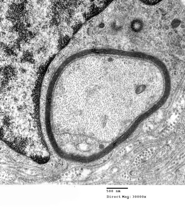 1F1B CIDP (Case 1)_041 - Copy